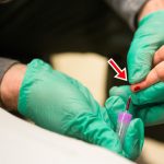 Ngộ độc chì ở trẻ